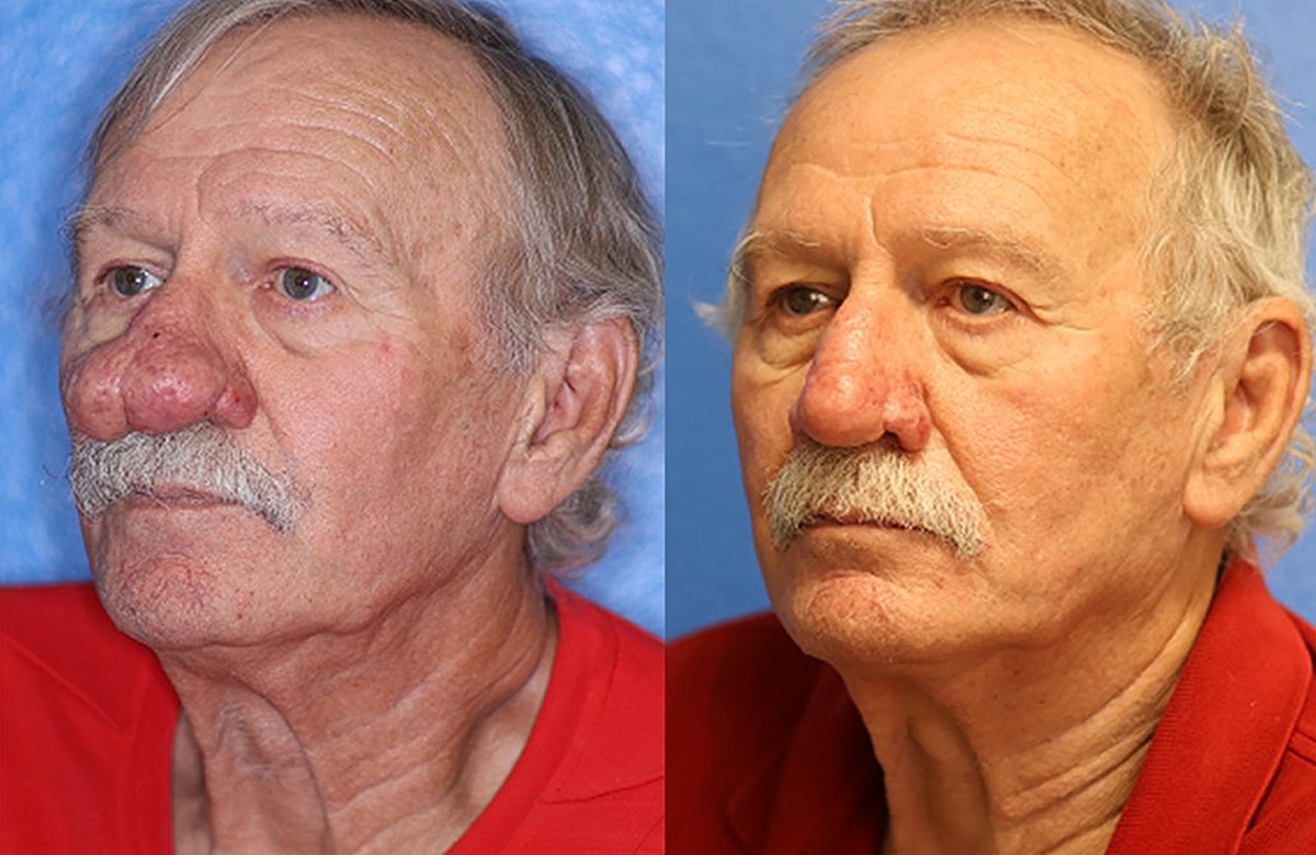 Rhinophyma Before & After