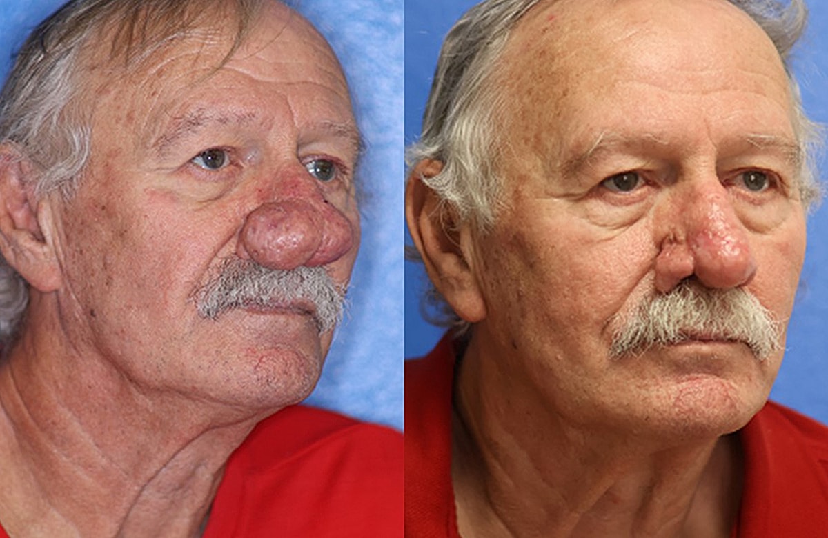 Rhinophyma Before & After