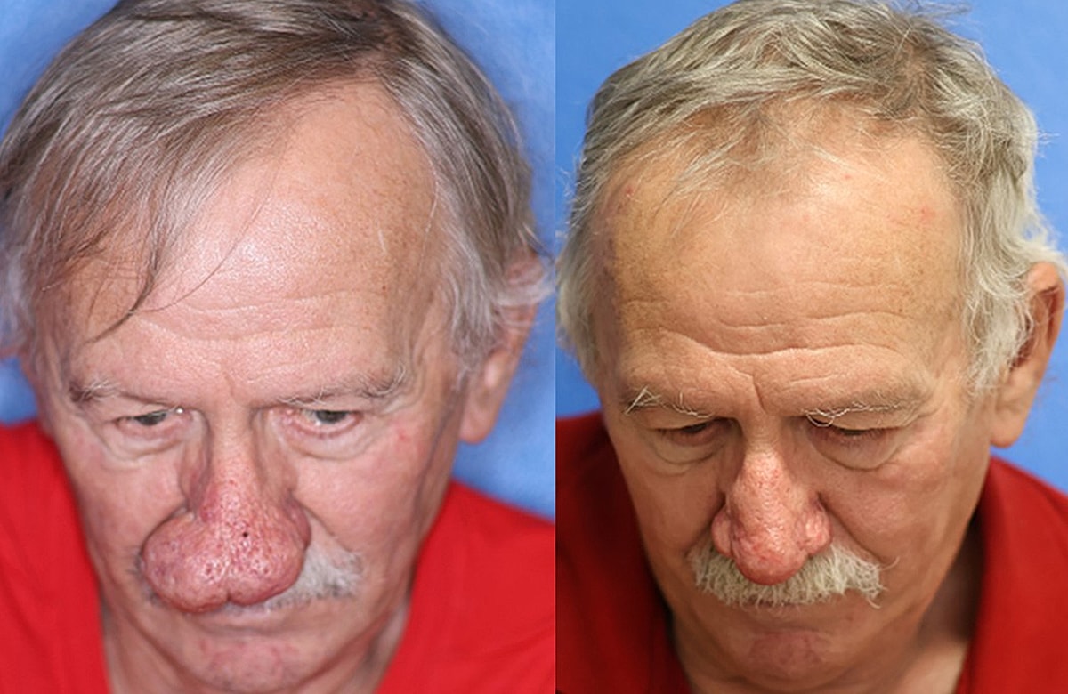 Rhinophyma Before & After