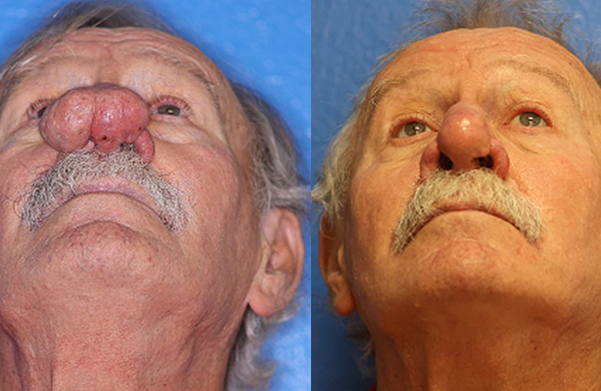 Rhinophyma Before & After