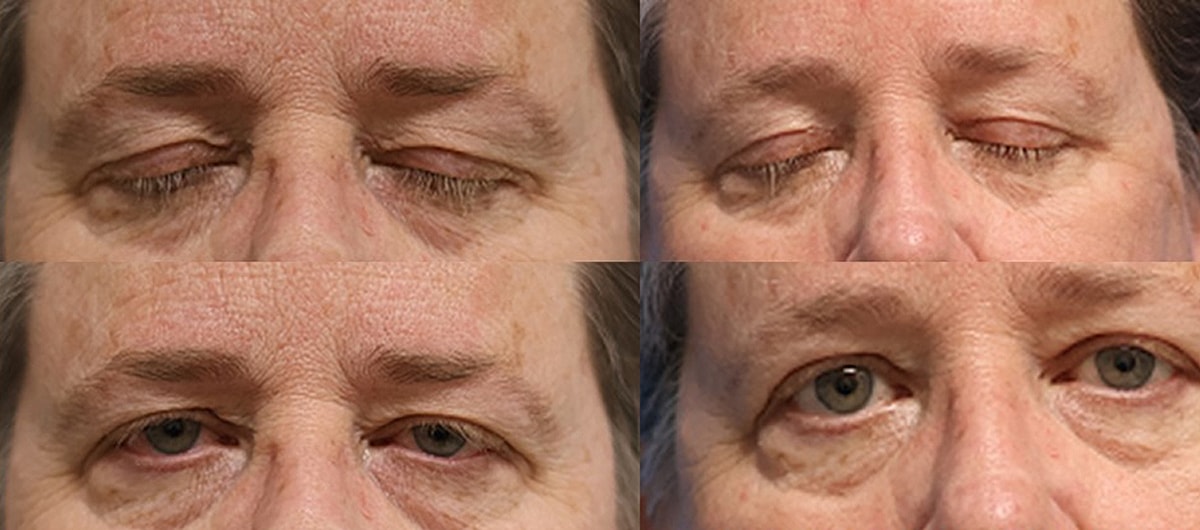 Upper Blepharoplasty Before & After