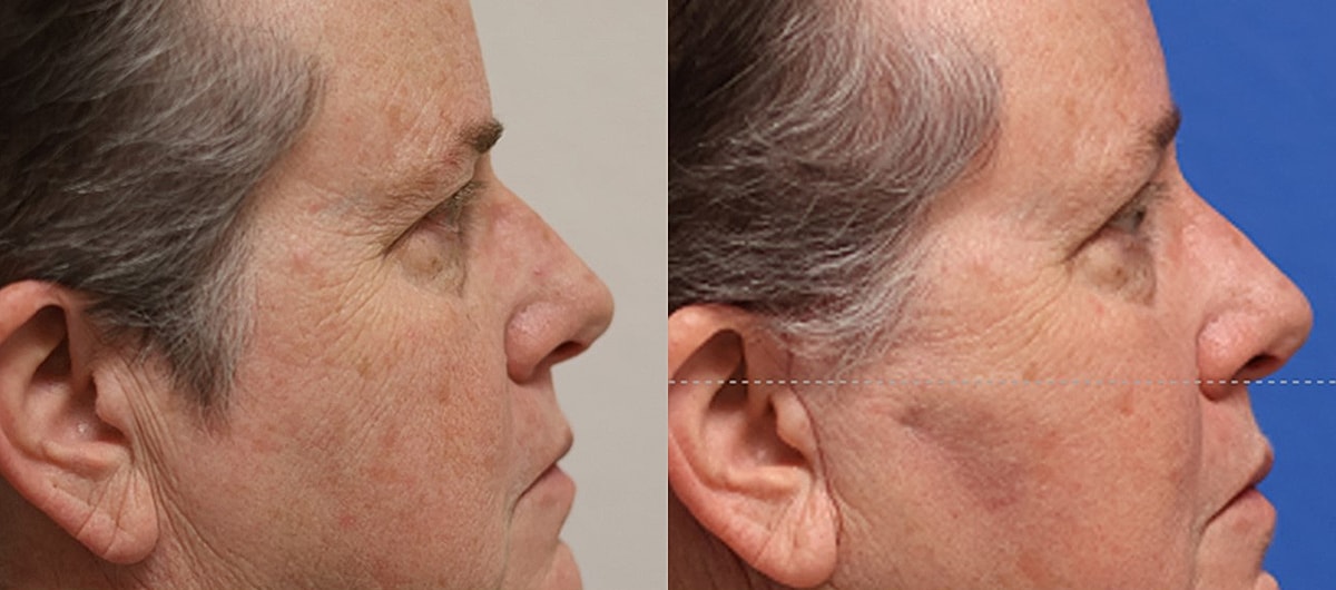 Upper Blepharoplasty Before & After