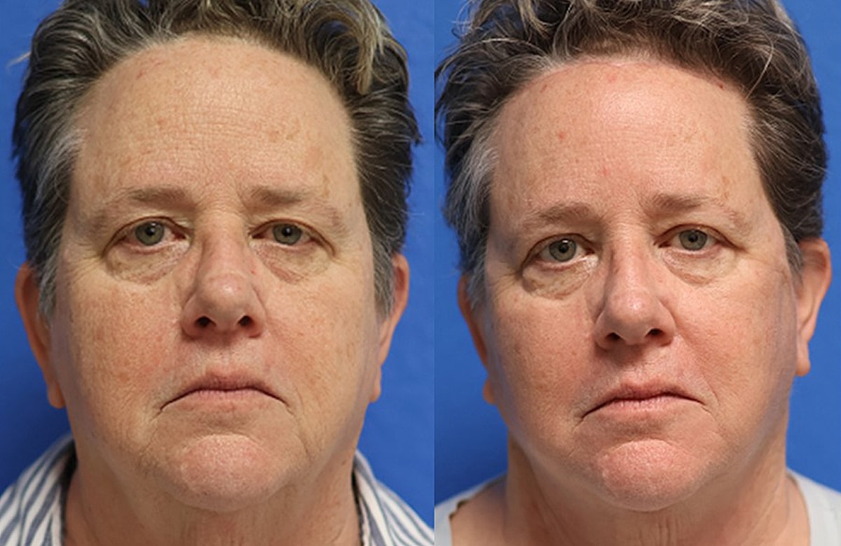 Face & Neck Lift Before & After