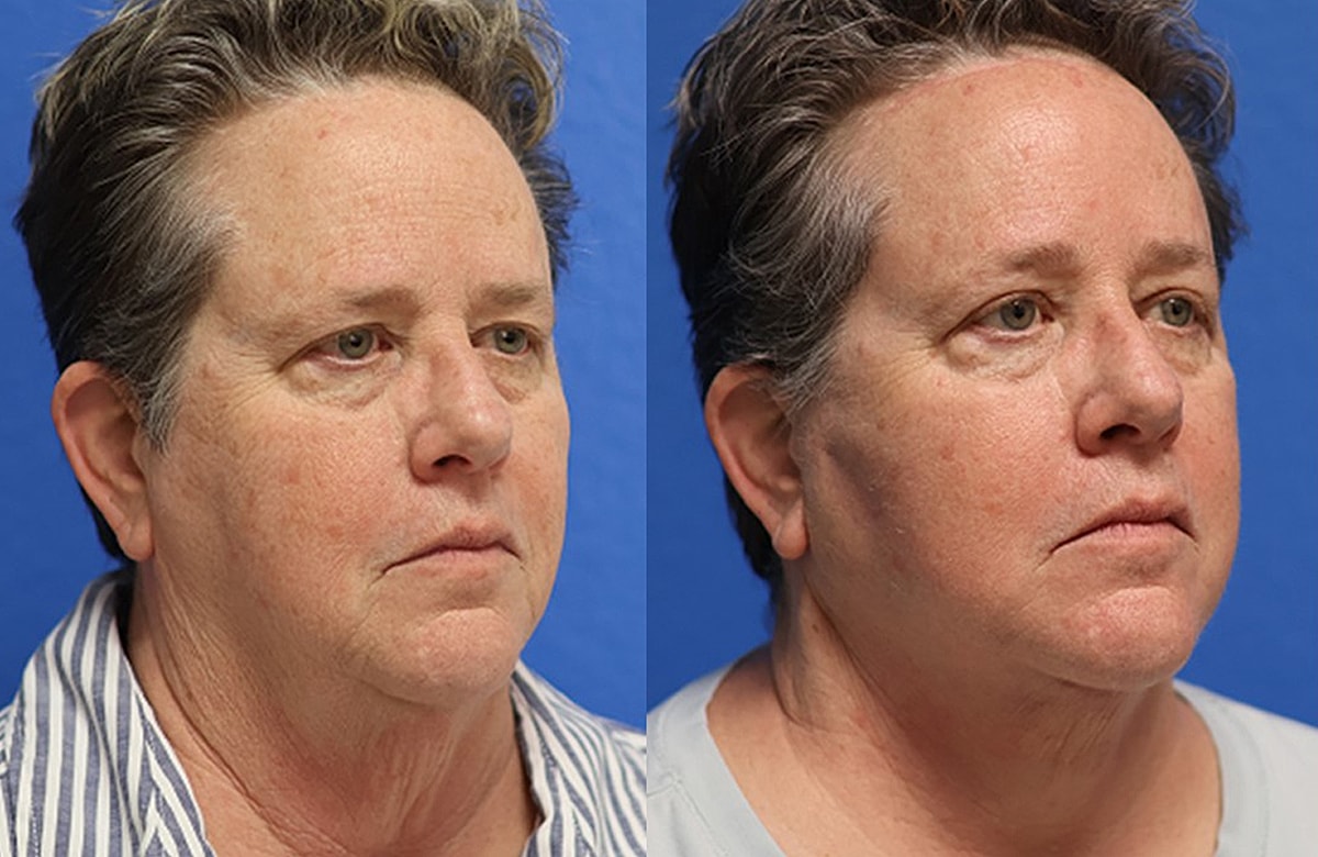 Face & Neck Lift Before & After