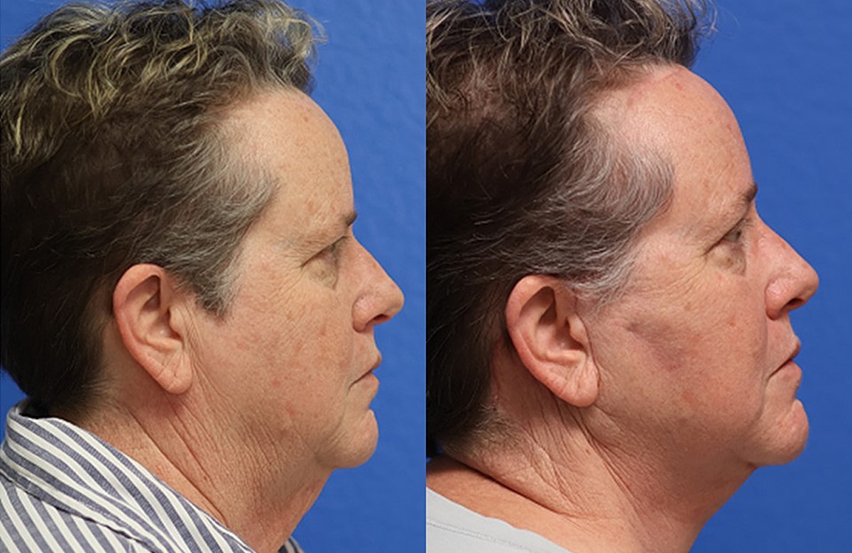 Face & Neck Lift Before & After