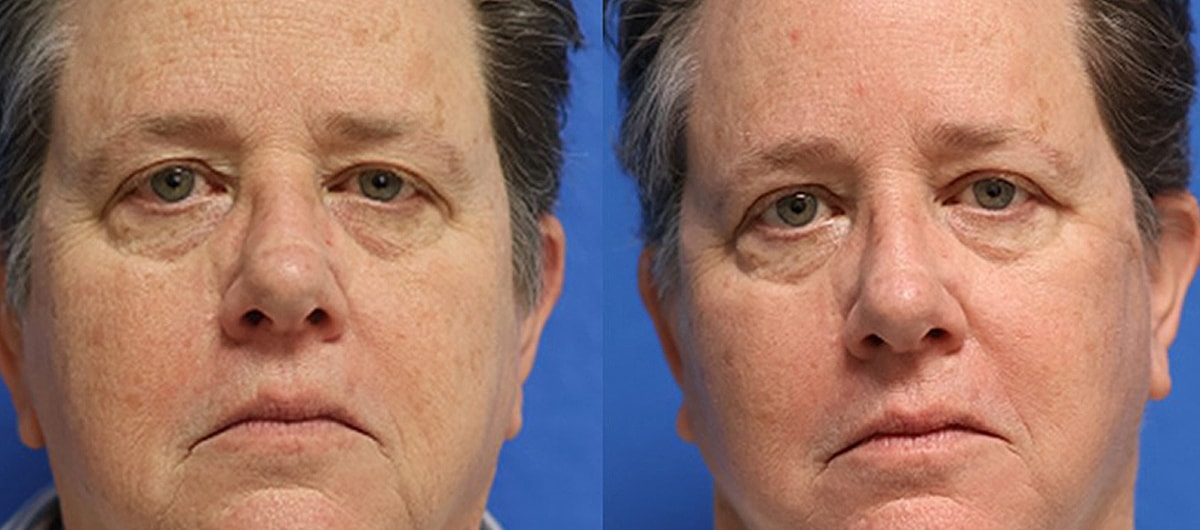 C02 Skin Resurfacing Before & After