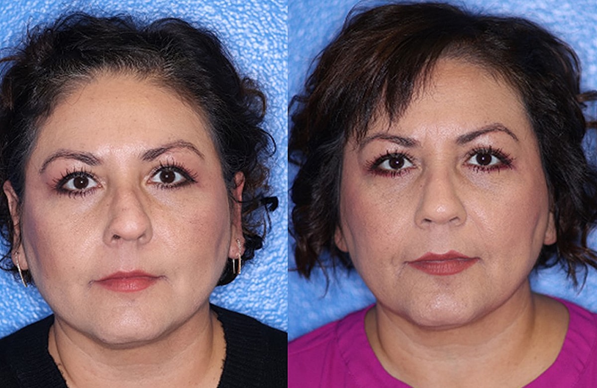 Rhinoplasty Before & After