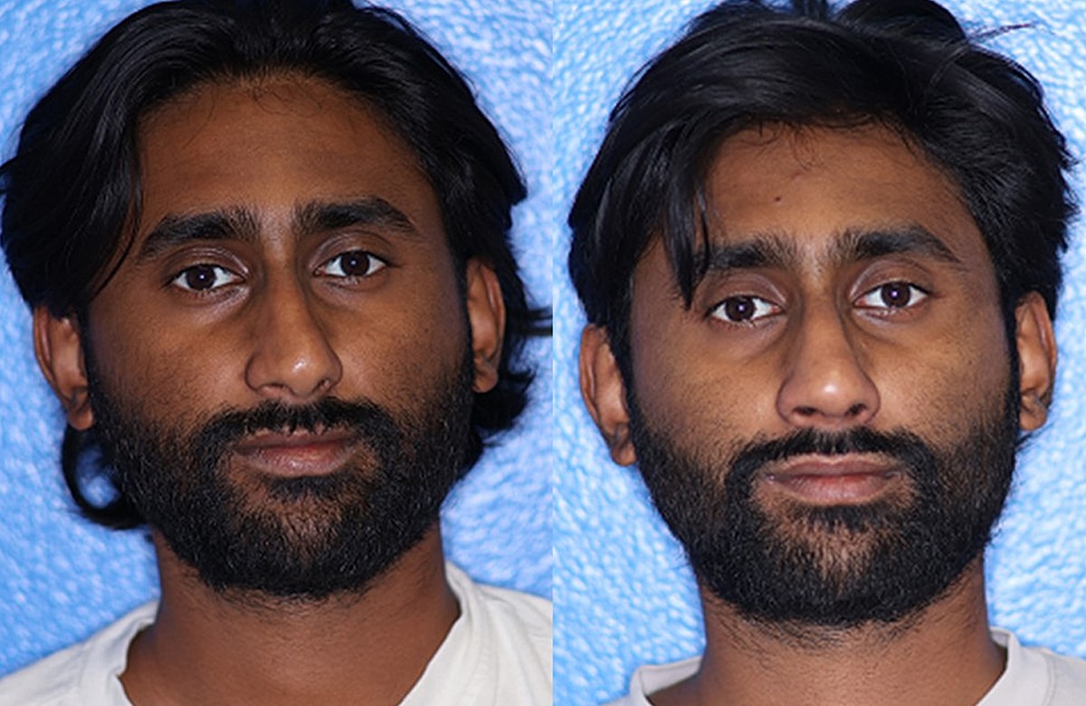 Rhinoplasty Before & After