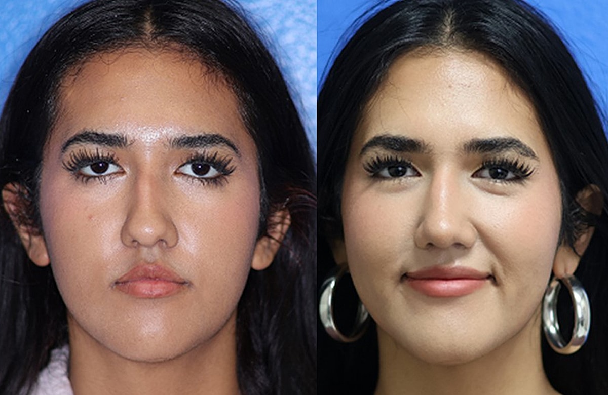 Rhinoplasty Before & After