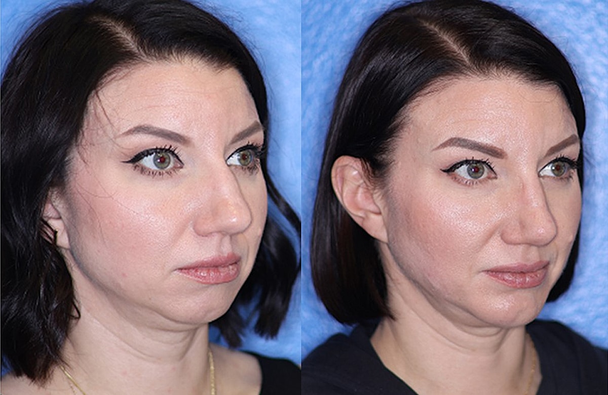Rhinoplasty Before & After