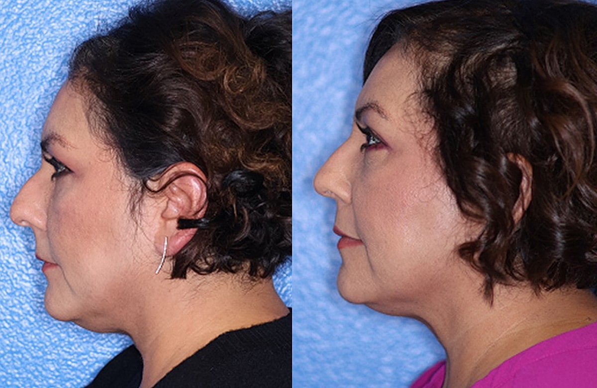 Rhinoplasty Before & After