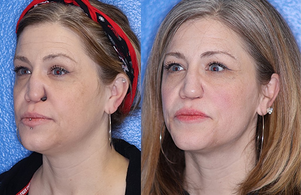 Rhinoplasty Before & After