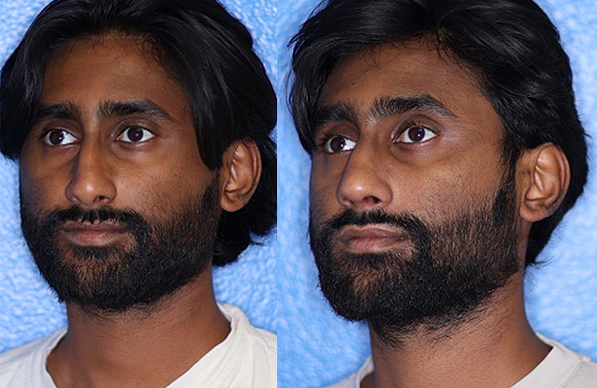 Rhinoplasty Before & After