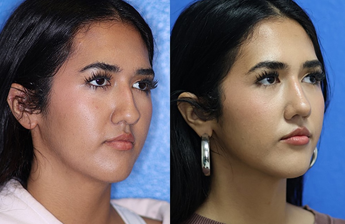 Rhinoplasty Before & After