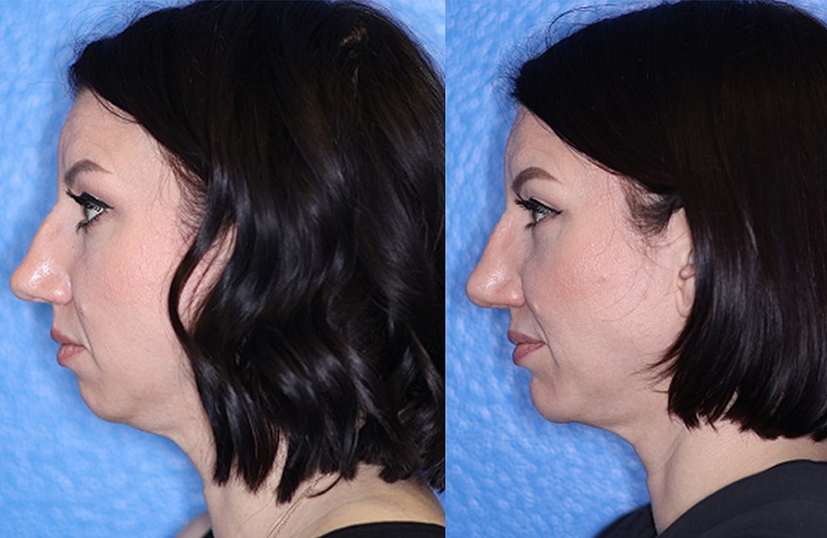Rhinoplasty Before & After