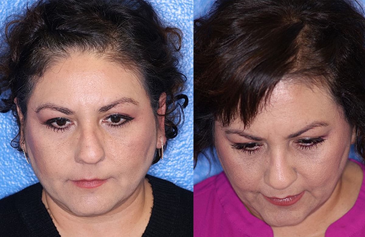 Rhinoplasty Before & After