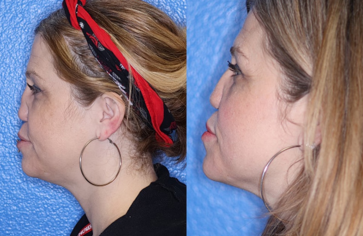 Rhinoplasty Before & After