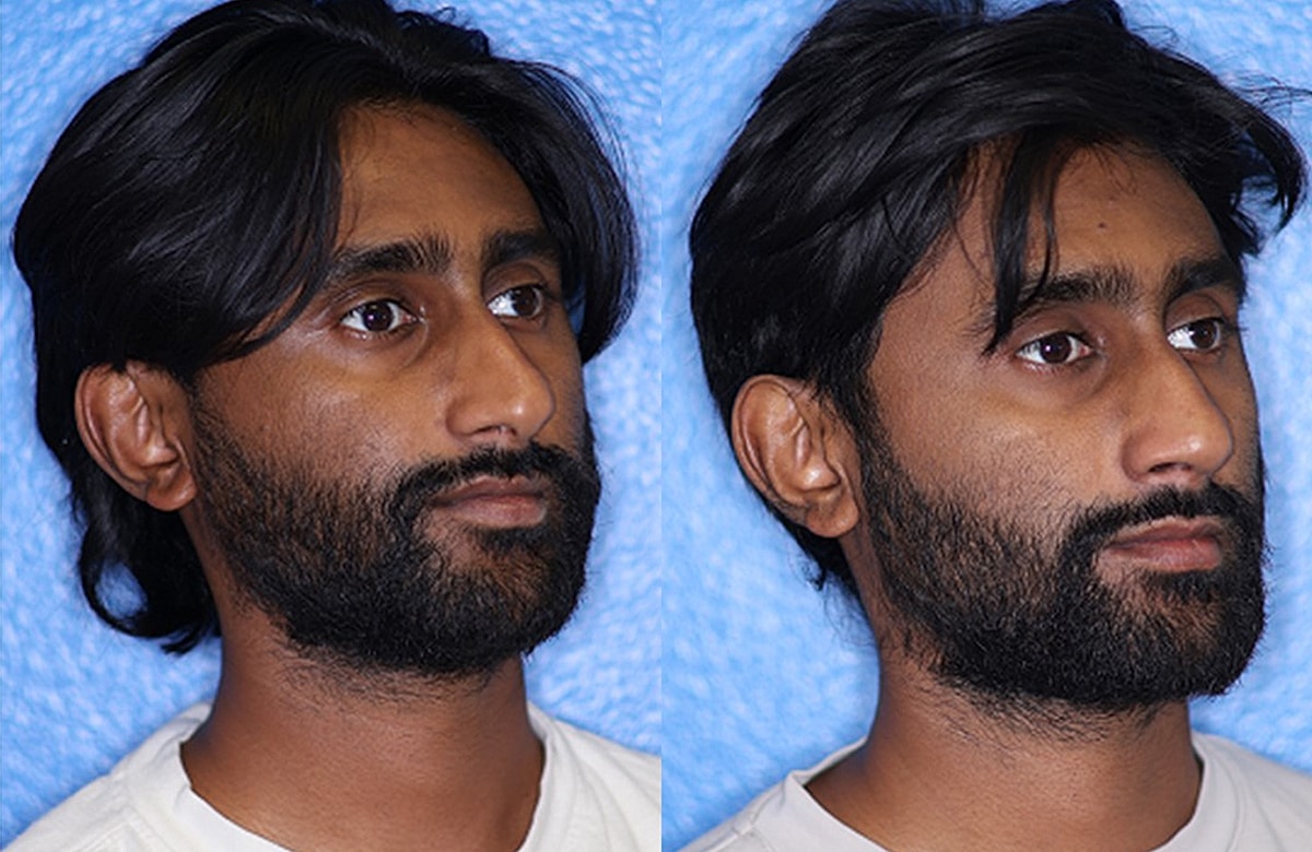 Rhinoplasty Before & After