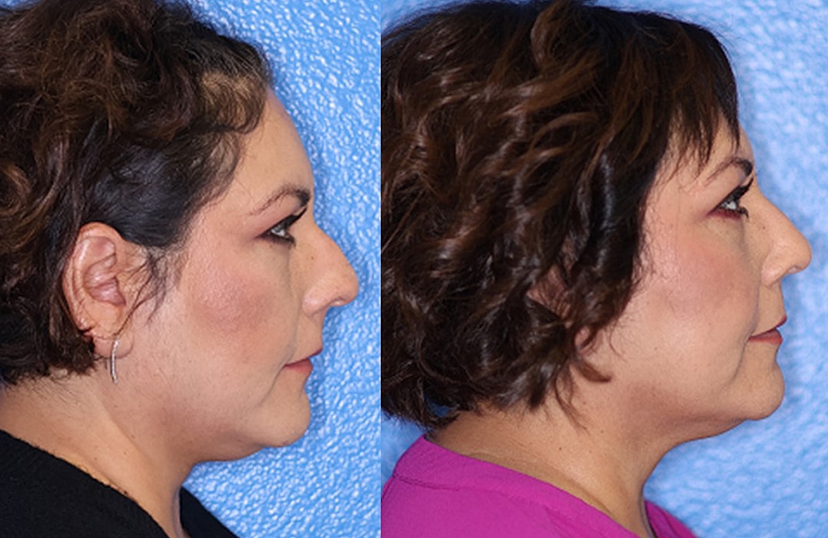 Rhinoplasty Before & After