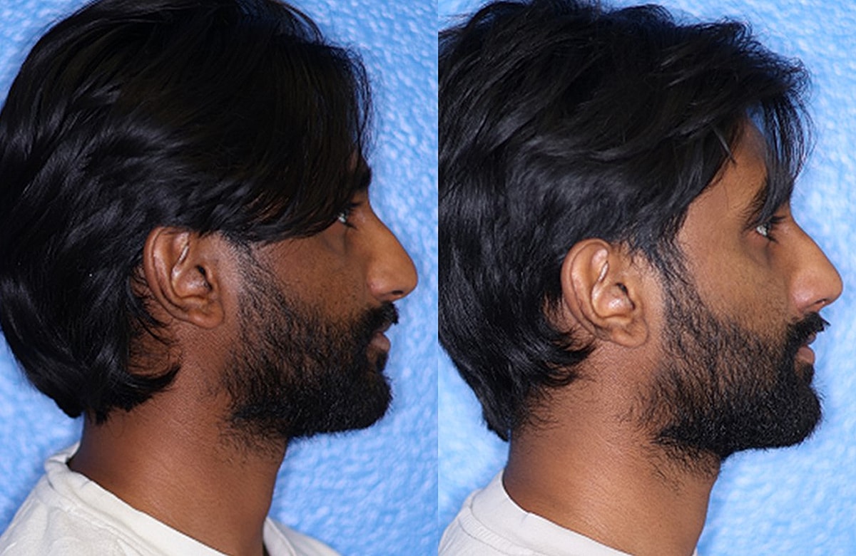 Rhinoplasty Before & After