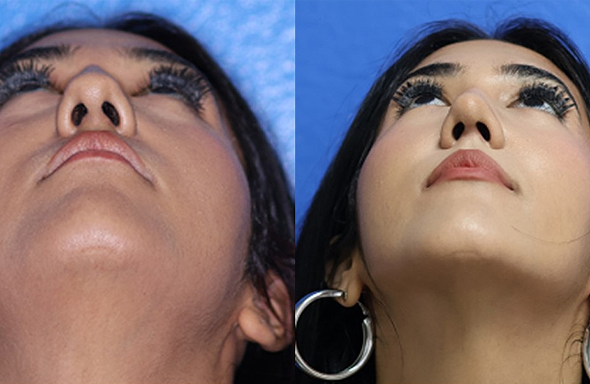 Rhinoplasty Before & After