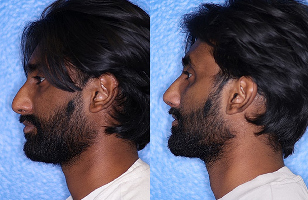 Rhinoplasty Before & After