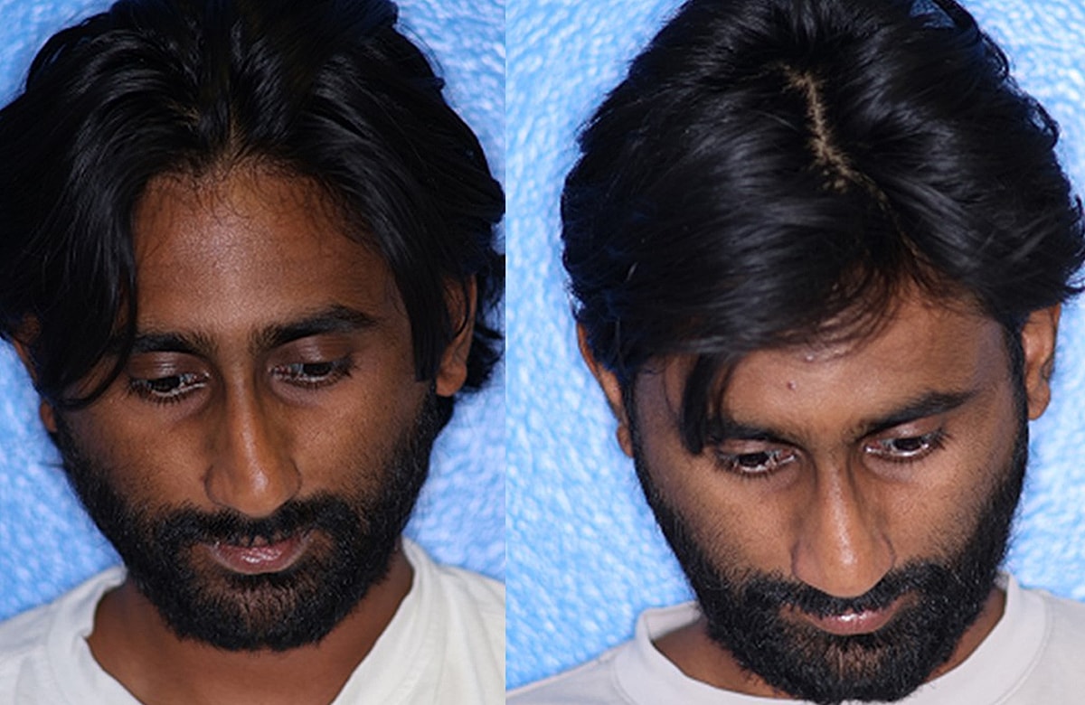 Rhinoplasty Before & After