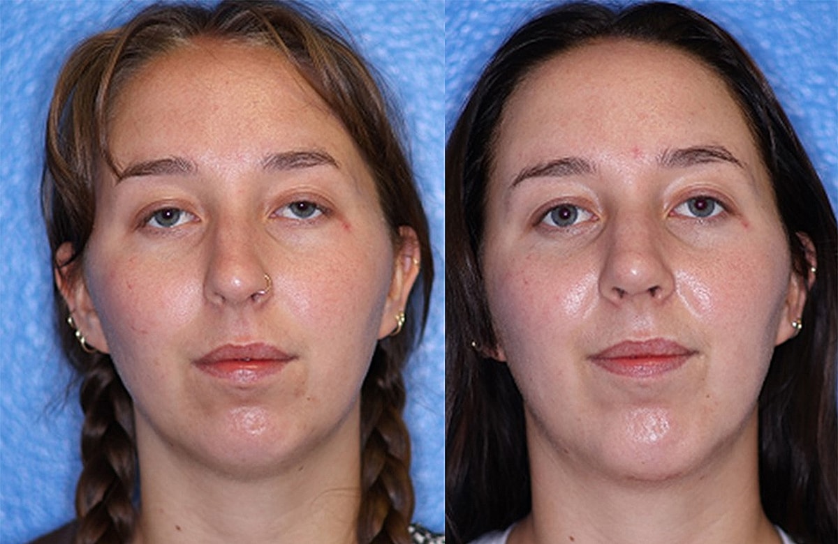 Before & After