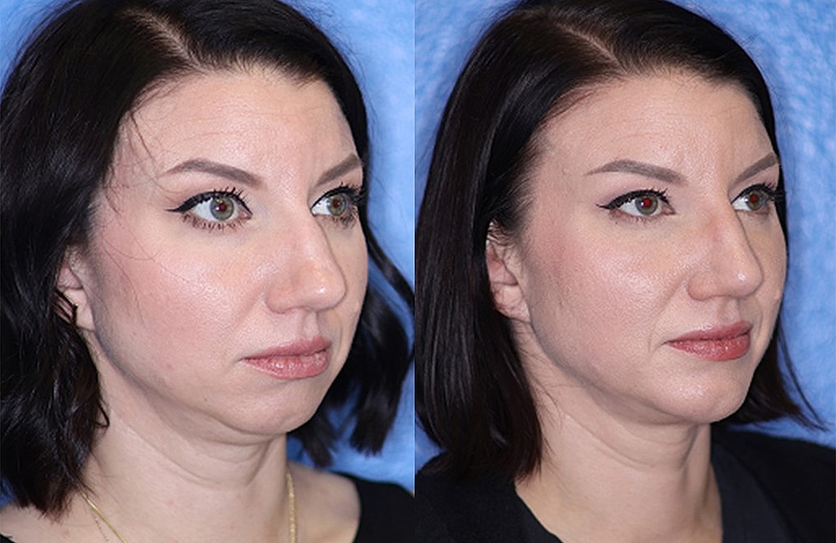 Before & After