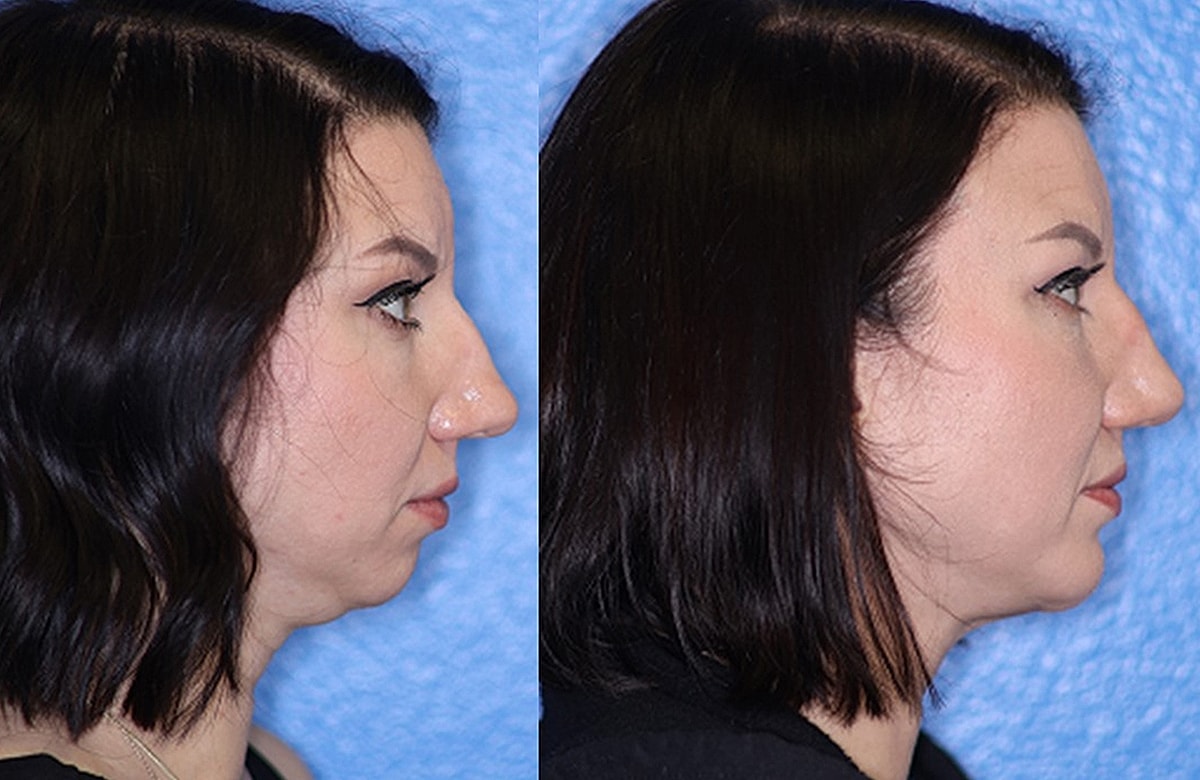 Before & After